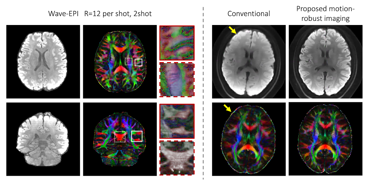 Diffusion MRI
